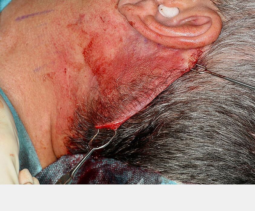 Optimal fitting of the skin flap