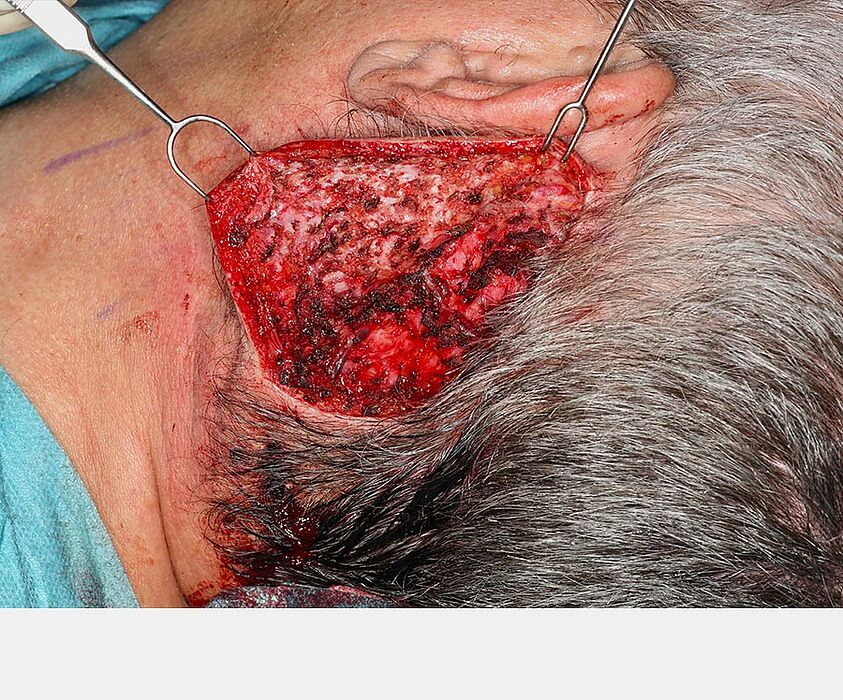 Large skin flap