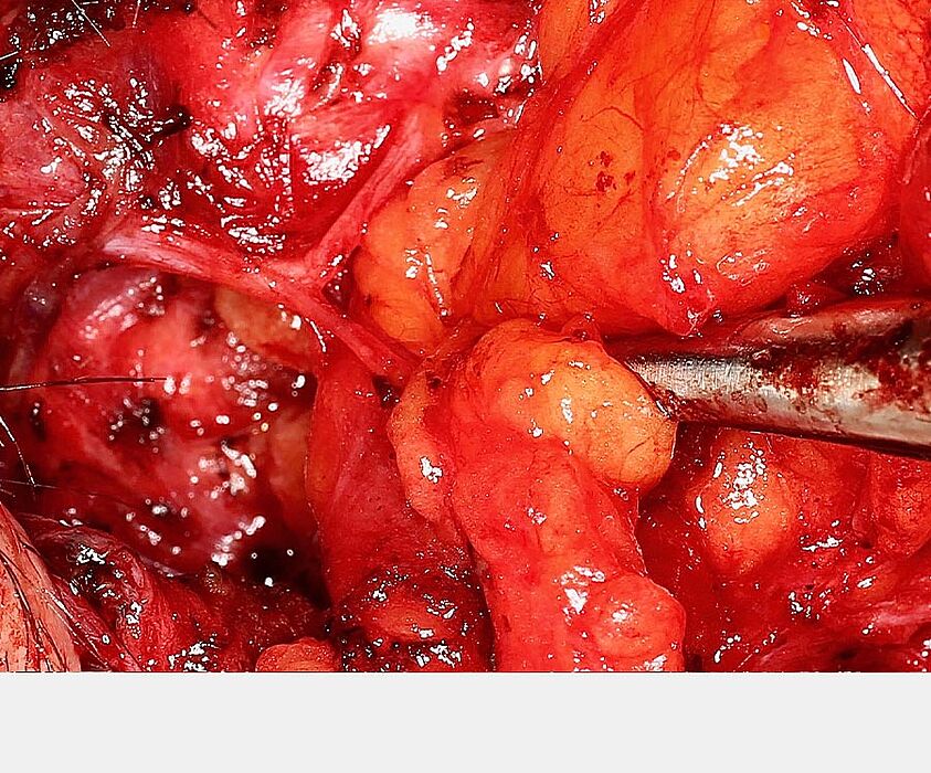 Further microsurgical tracing / visualisation of the nerve