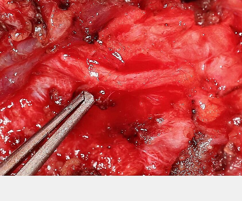 Enlargement of the exposed nerve trunk