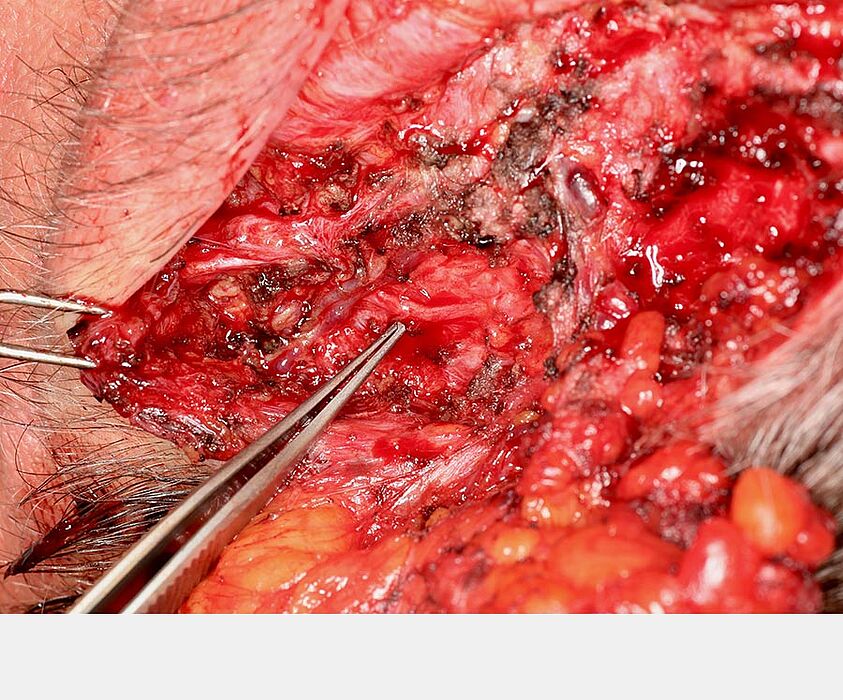The nerve trunk, microsurgically visualised