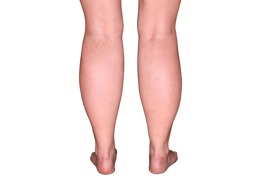 Lower legs / calves preoperatively 2