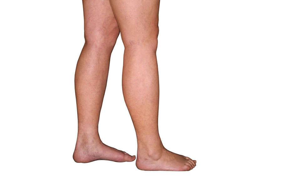 Lower legs / calves postoperatively 3