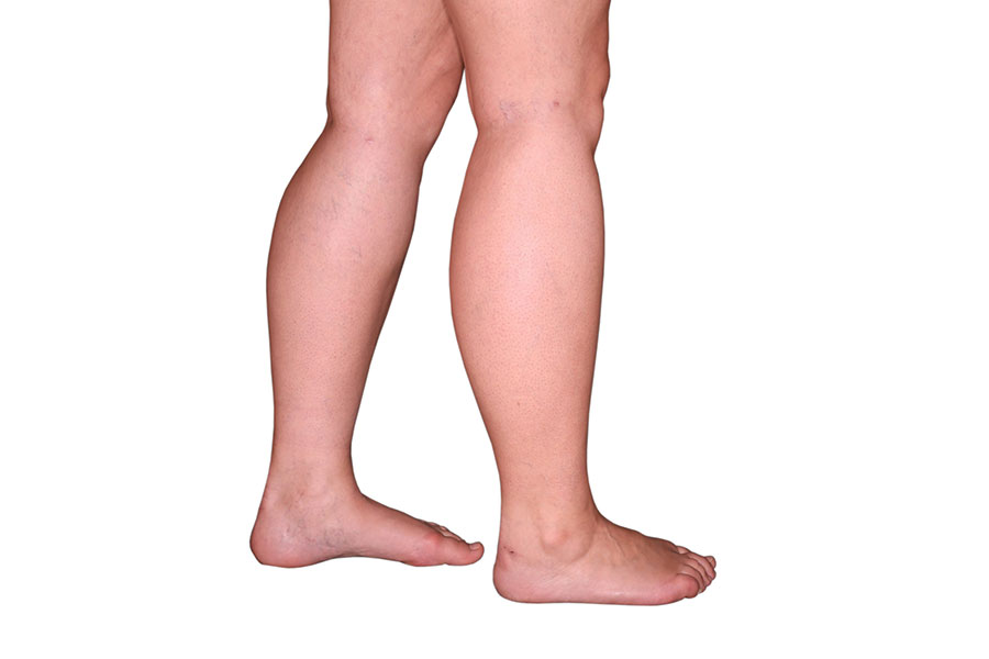 Lower legs / calves preoperatively 3