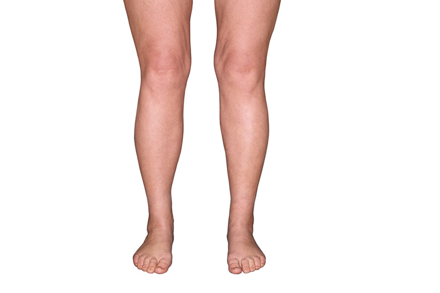 Lower legs / calves postoperatively 1